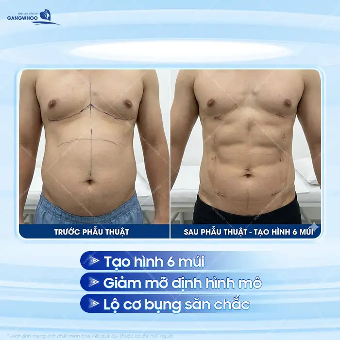 Hút mỡ bụng tạo hình 6 múi có hiệu quả không? Những ai nên thực hiện