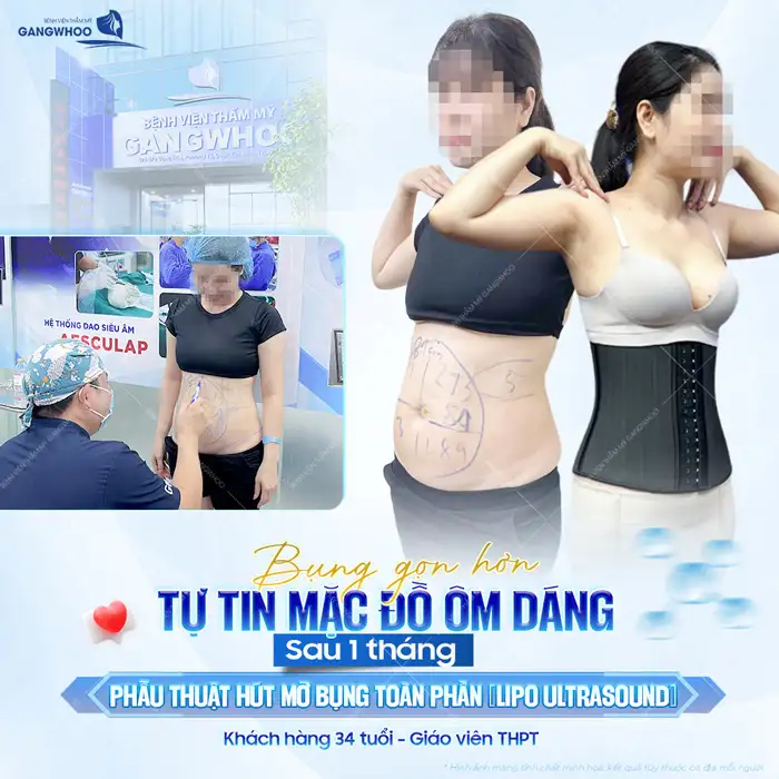 Hút mỡ bụng trả góp ở đâu uy tín? Điều kiện và lãi suất ra sao?