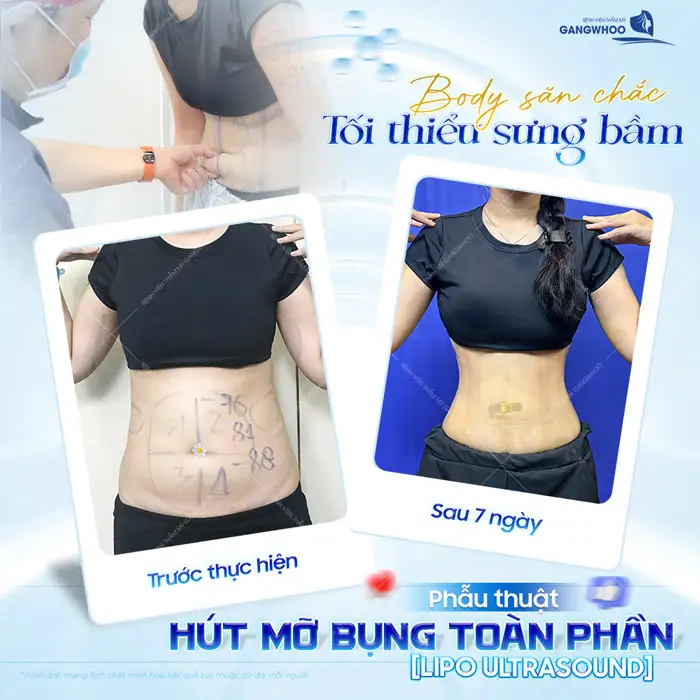 Hút mỡ bụng trên là gì? Có đau không và bao lâu thì hồi phục?