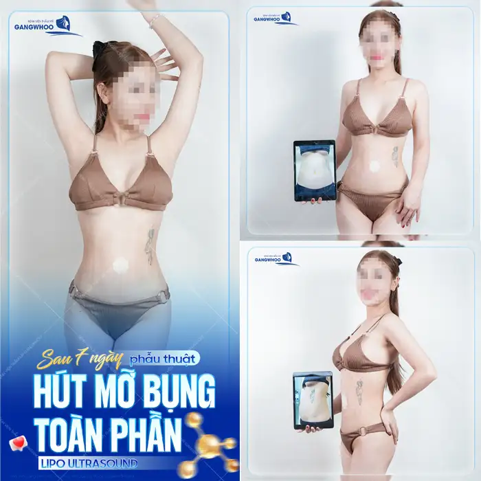 Hút mỡ bụng trên là gì? Có đau không và bao lâu thì hồi phục?