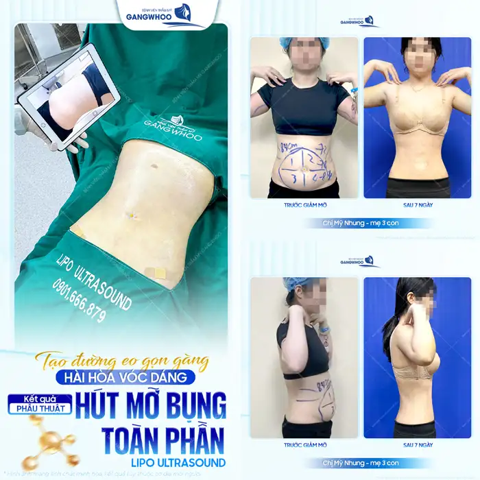 Hút mỡ bụng trên là gì? Có đau không và bao lâu thì hồi phục?