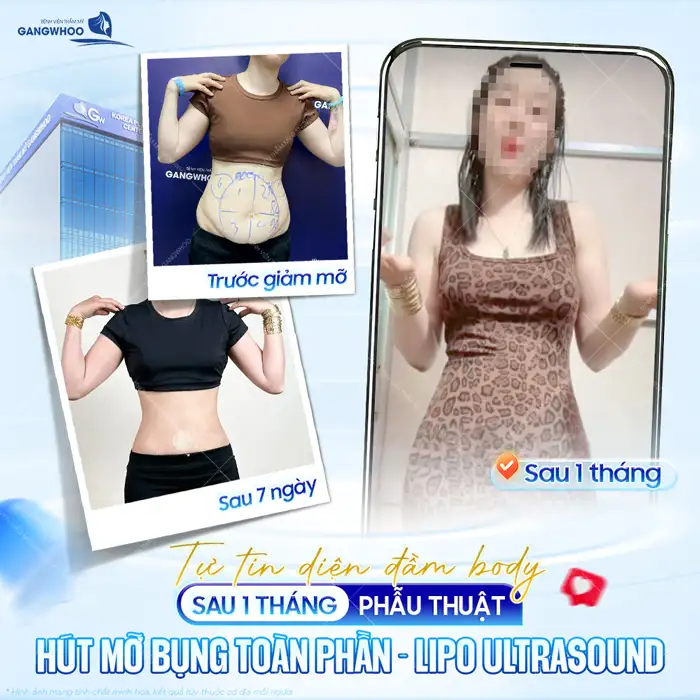 Hút mỡ bụng trên là gì? Có đau không và bao lâu thì hồi phục?