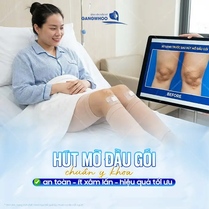 Phương pháp hút mỡ đầu gối là gì? Có nên thực hiện hút đầu gối?