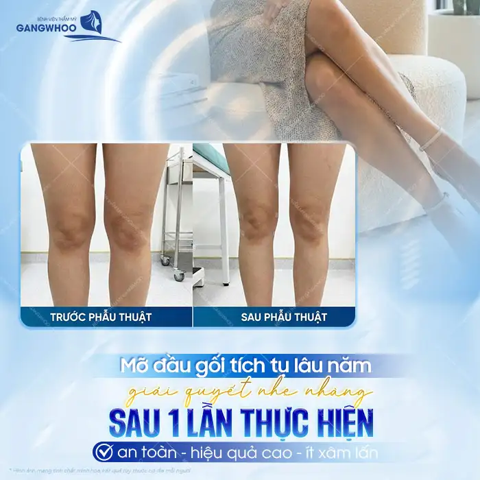 Phương pháp hút mỡ đầu gối là gì? Có nên thực hiện hút đầu gối?