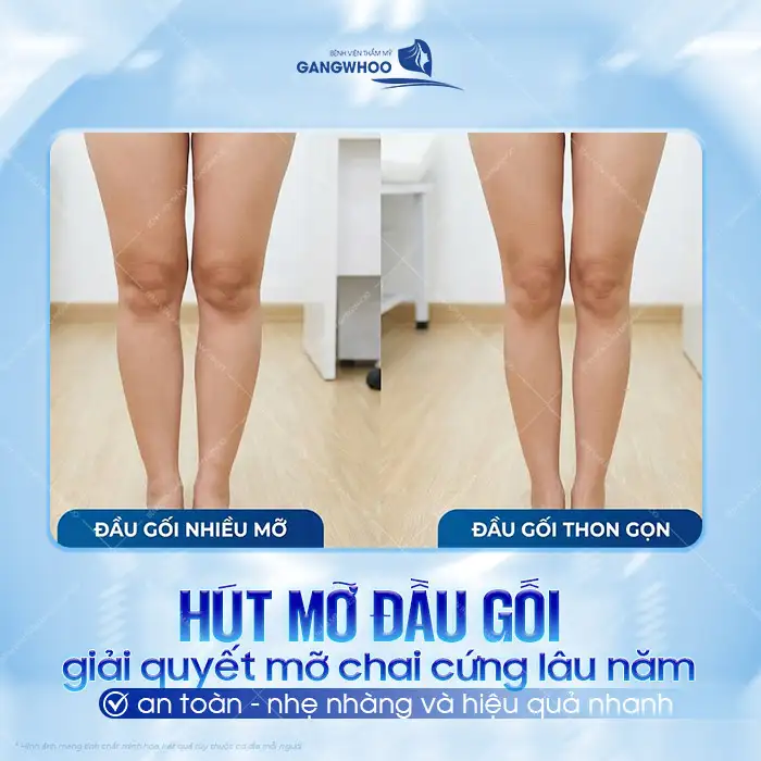 Phương pháp hút mỡ đầu gối là gì? Có nên thực hiện hút đầu gối?