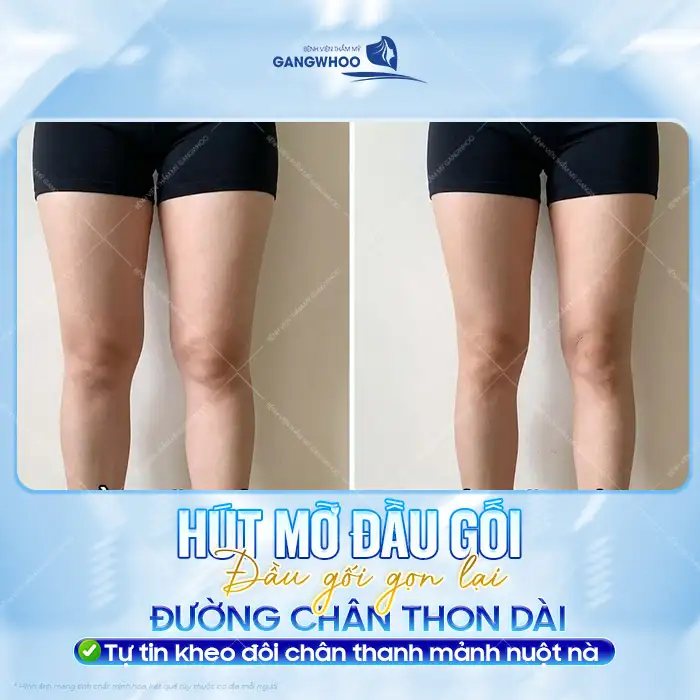 Phương pháp hút mỡ đầu gối là gì? Có nên thực hiện hút đầu gối?