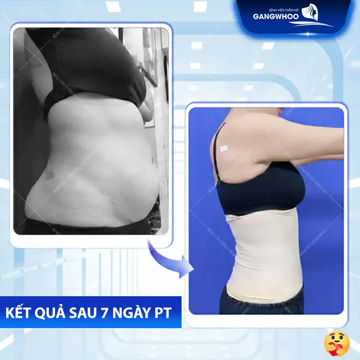 Hút mỡ lưng bao nhiêu tiền? Bảng giá hút mỡ cập nhật mới nhất 2025