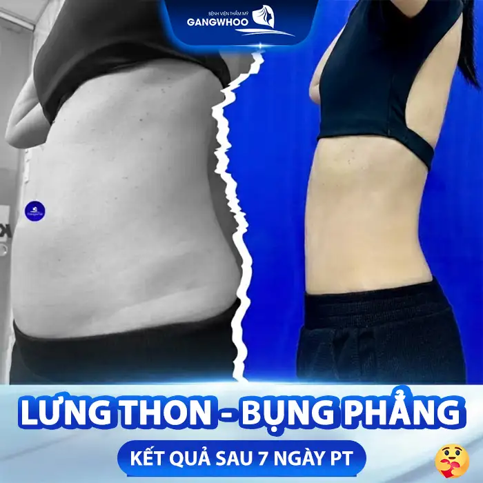 Hút mỡ lưng bao nhiêu tiền? Bảng giá hút mỡ cập nhật mới nhất 2025