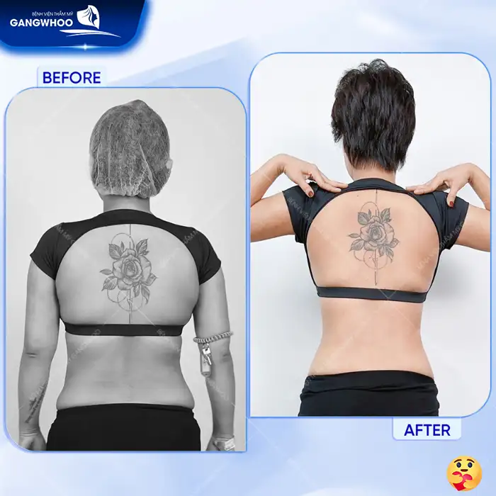 Hút mỡ lưng bao nhiêu tiền? Bảng giá hút mỡ cập nhật mới nhất 2025