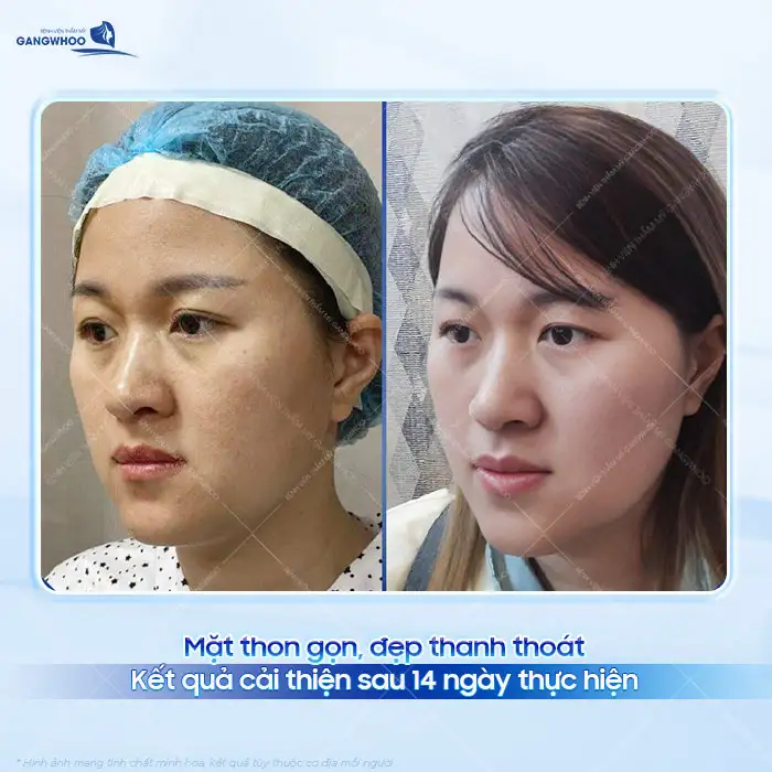 Hút mỡ mặt có nguy hiểm không? Có nên thực hiện hút mỡ mặt