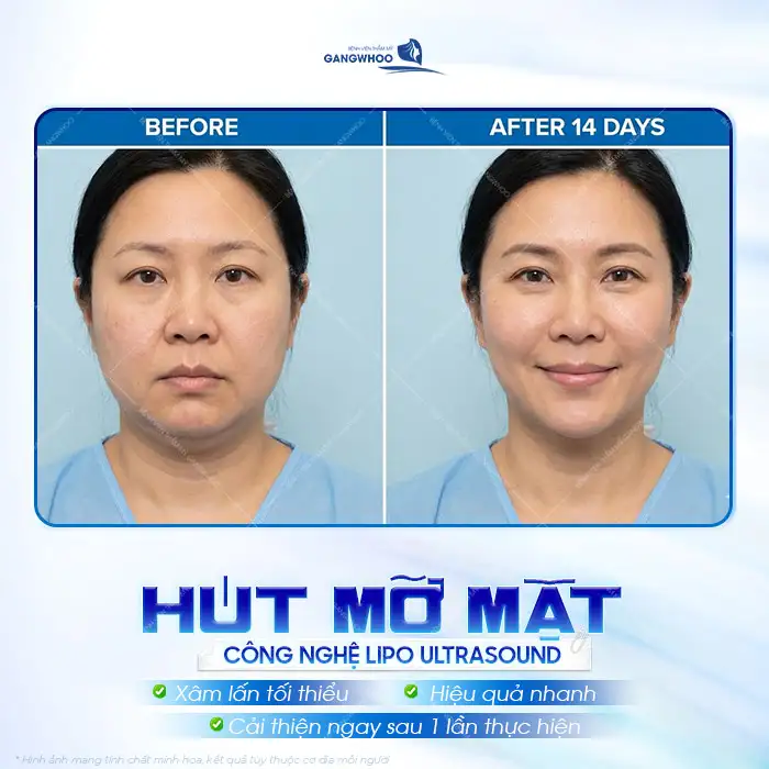 Hút mỡ mặt có nguy hiểm không? Có nên thực hiện hút mỡ mặt