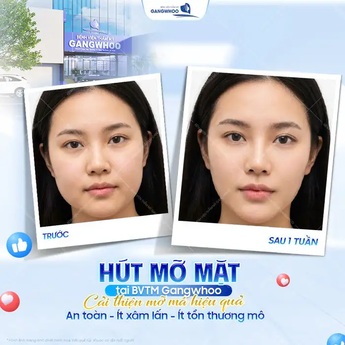 Hút mỡ mặt có nguy hiểm không? Có nên thực hiện hút mỡ mặt