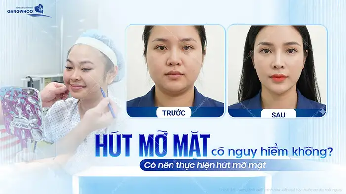 Hút mỡ mặt có nguy hiểm không? Có nên thực hiện hút mỡ mặt