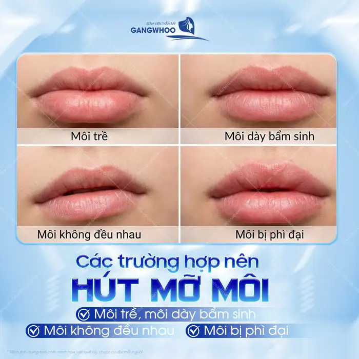 Phương pháp hút mỡ môi là gì? Có nên thực hiện hút mỡ môi?