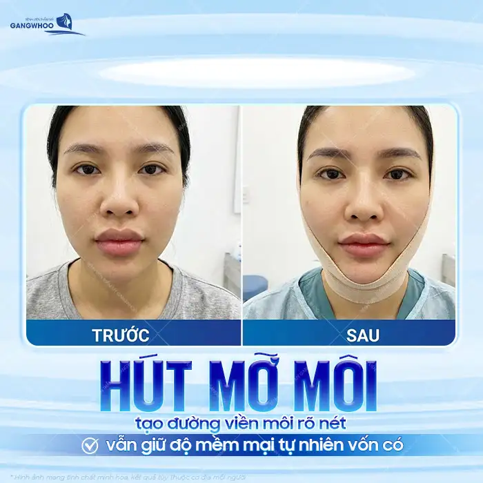 Phương pháp hút mỡ môi là gì? Có nên thực hiện hút mỡ môi?