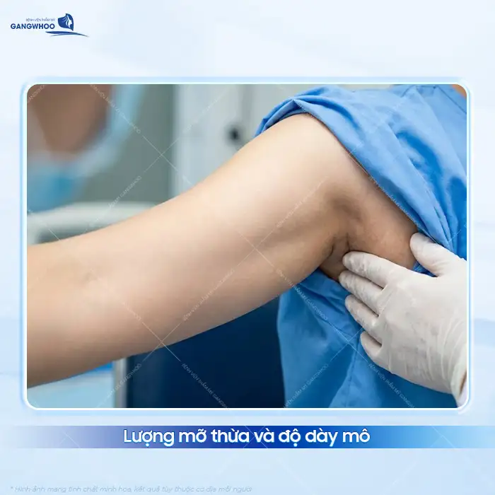 Hút mỡ nách bao nhiêu tiền? Bảng giá hút mỡ cập nhật mới nhất 2025