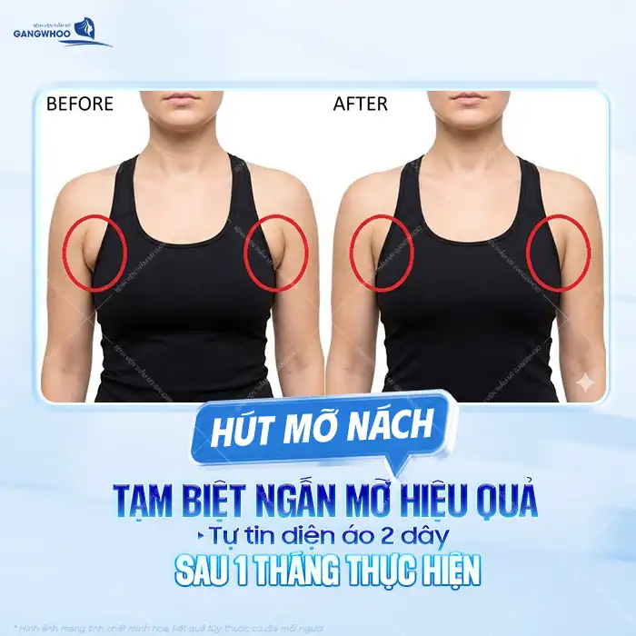 Hút mỡ nách bao nhiêu tiền? Bảng giá hút mỡ cập nhật mới nhất 2025
