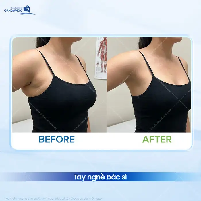 Hút mỡ nách bao nhiêu tiền? Bảng giá hút mỡ cập nhật mới nhất 2025