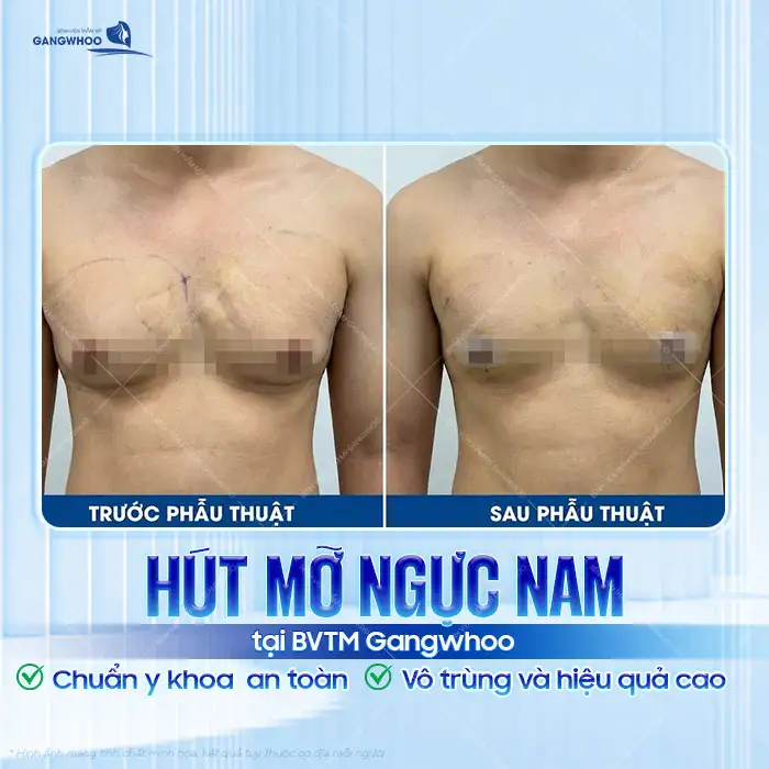 Hút mỡ ngực nam là gì? Quy trình, và hiệu quả thực tế ra sao?