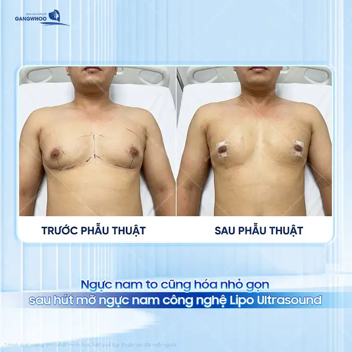 Hút mỡ ngực nam là gì? Quy trình, và hiệu quả thực tế ra sao?