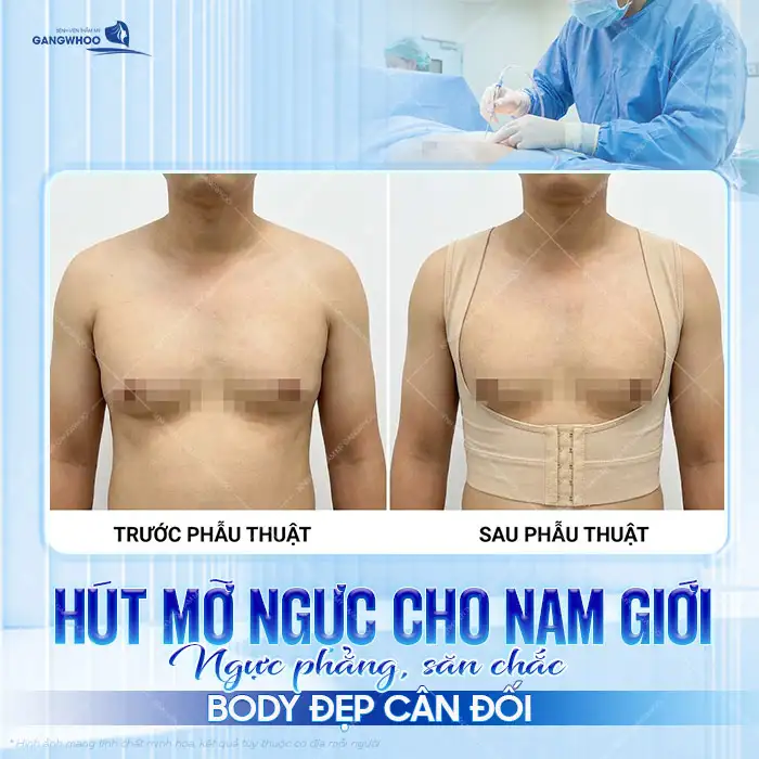 Hút mỡ ngực nam là gì? Quy trình, và hiệu quả thực tế ra sao?