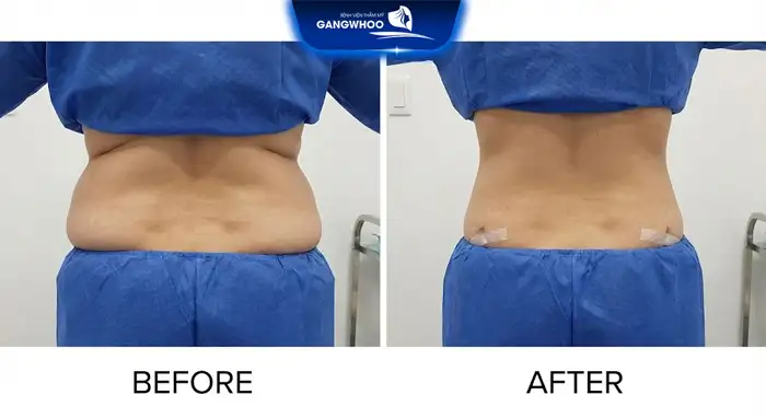 Hút mỡ 2 bên hông là gì? Có nên lựa chọn hút mỡ vùng hông