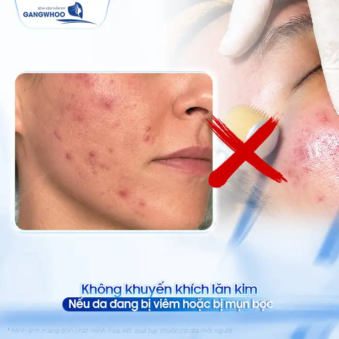 Phương pháp lăn kim điều trị mụn liệu có hiệu quả? Có nên thực hiện
