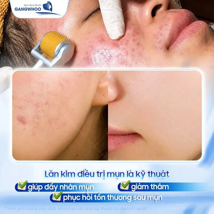 Phương pháp lăn kim điều trị mụn liệu có hiệu quả? Có nên thực hiện