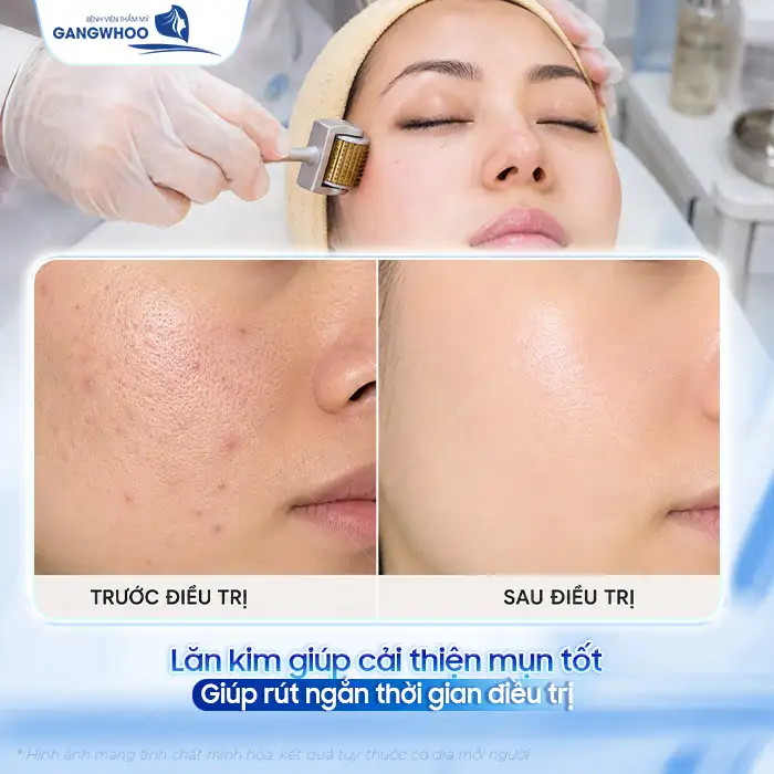 Phương pháp lăn kim điều trị mụn liệu có hiệu quả? Có nên thực hiện