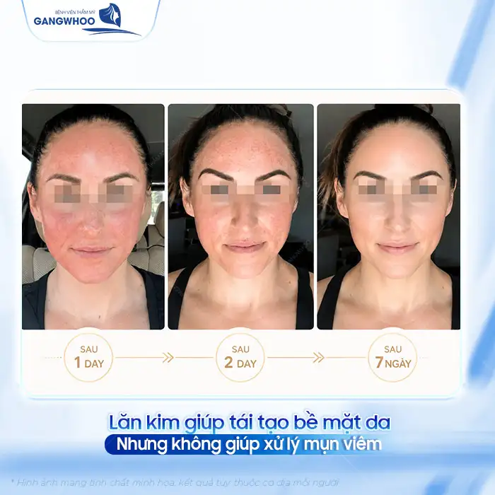 Phương pháp lăn kim điều trị mụn liệu có hiệu quả? Có nên thực hiện
