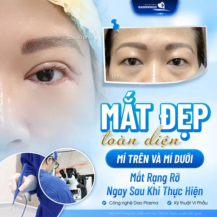 Lấy bọng mỡ mắt dưới bao lâu thì lành? Quy trình hồi phục ra sao?