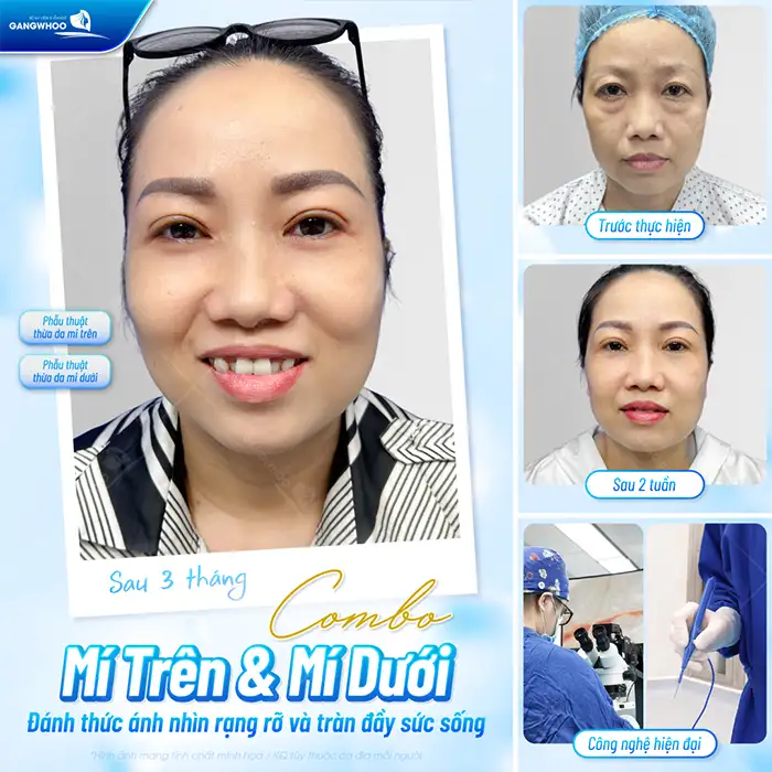 Lấy bọng mỡ mắt dưới bao lâu thì lành? Quy trình hồi phục ra sao?