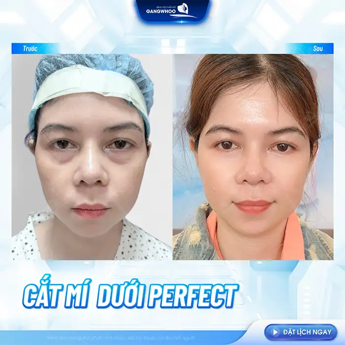 Lấy bọng mỡ mắt dưới bao lâu thì lành? Quy trình hồi phục ra sao?