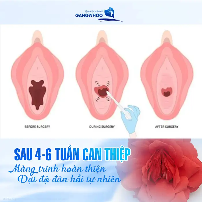 Màng trinh rách lâu có thể vá được không? Cần lưu ý những gì?