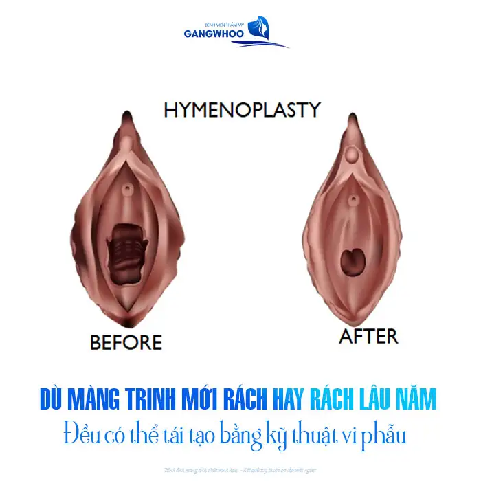 Màng trinh rách lâu có thể vá được không? Cần lưu ý những gì?