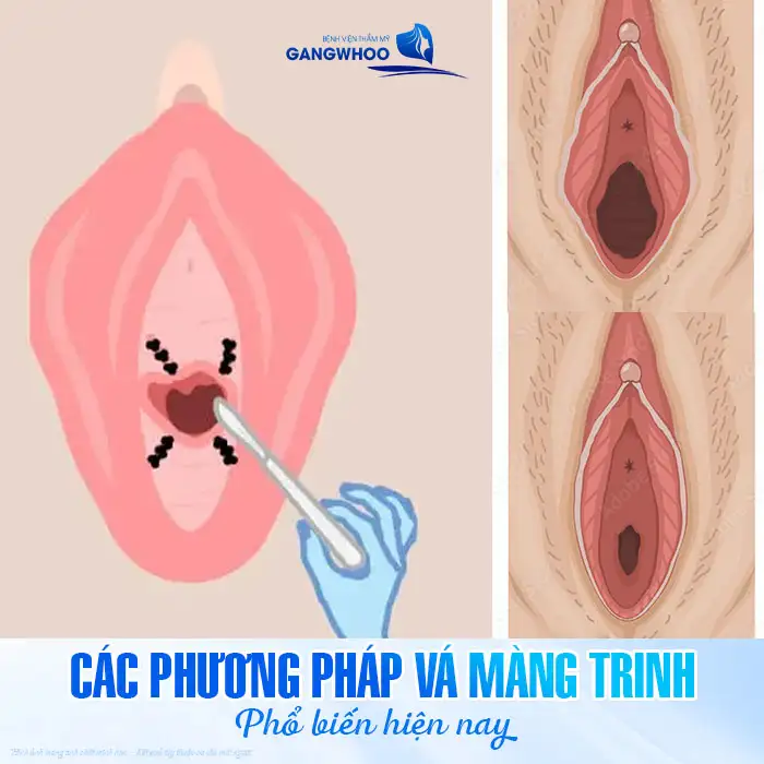 Màng trinh rách lâu có thể vá được không? Cần lưu ý những gì?
