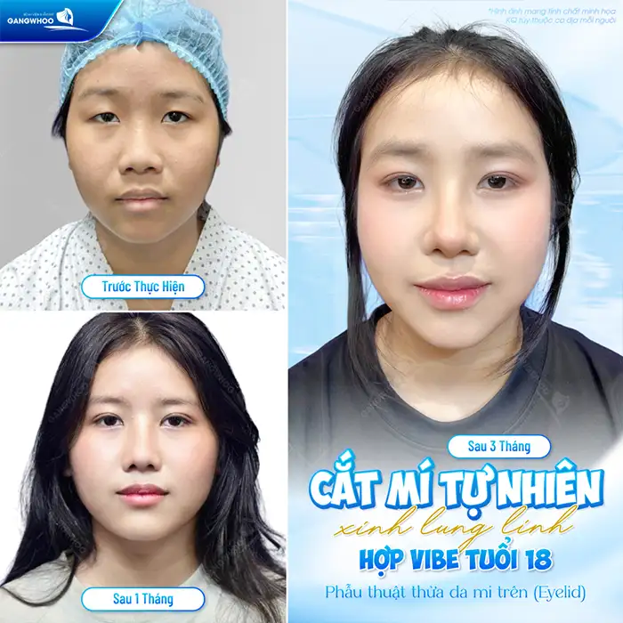 Mắt mí lót có nên cắt mí không? Nên lưu ý an toàn trước khi cắt mí