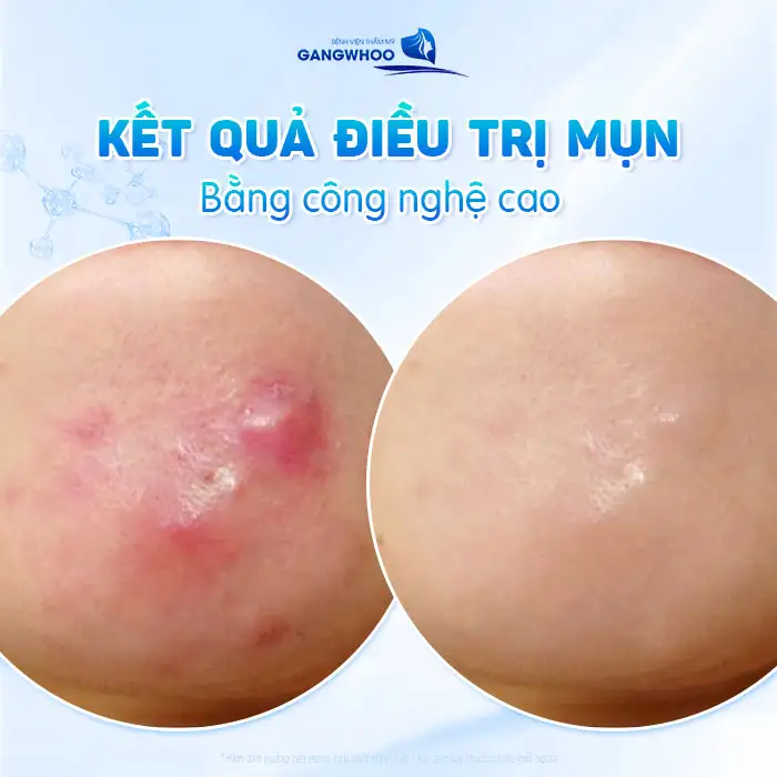 Nguyên nhân gây mụn bọc và cách điều trị không để lại sẹo xấu