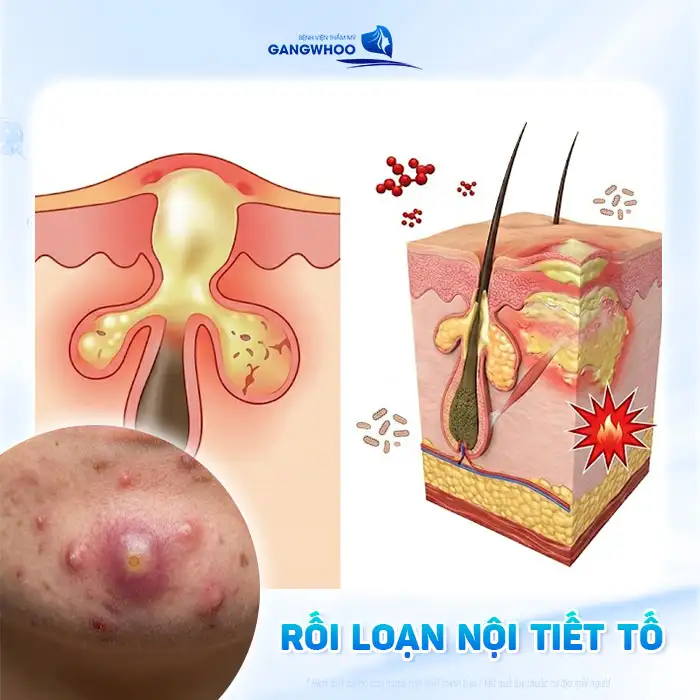 Nguyên nhân gây mụn bọc và cách điều trị không để lại sẹo xấu
