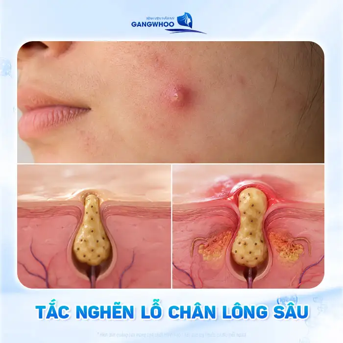 Nguyên nhân gây mụn bọc và cách điều trị không để lại sẹo xấu