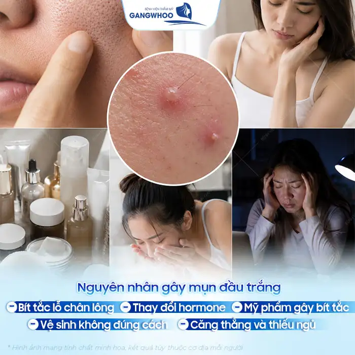 Mụn đầu trắng và cách điều trị chuẩn y khoa, sạch mụn nhanh