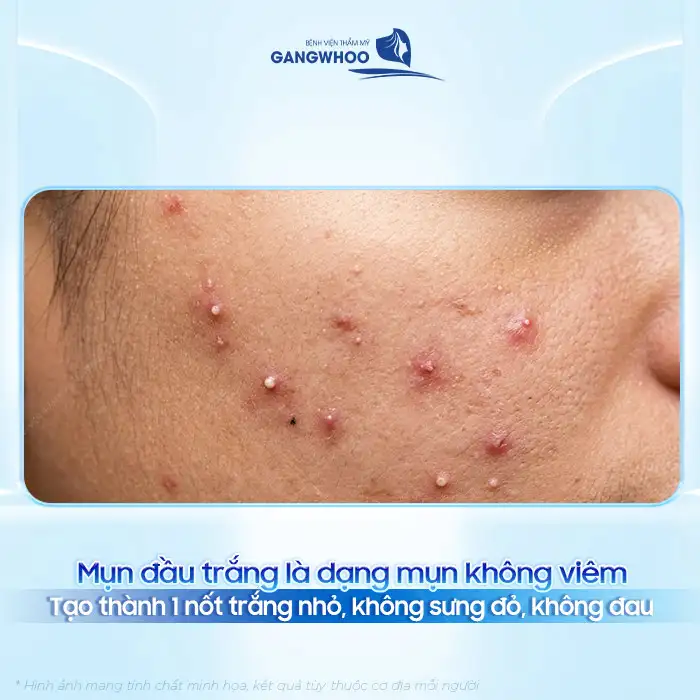 Mụn đầu trắng và cách điều trị chuẩn y khoa, sạch mụn nhanh