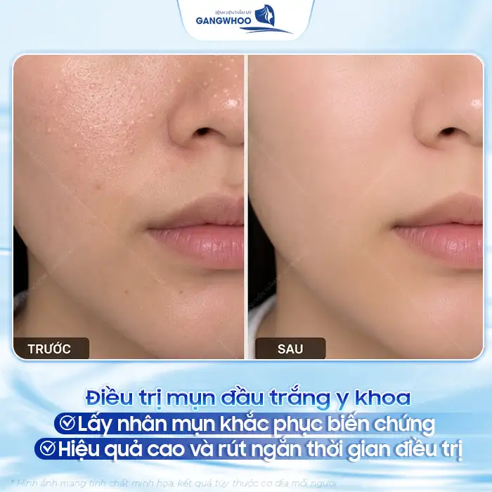 Mụn đầu trắng và cách điều trị chuẩn y khoa, sạch mụn nhanh