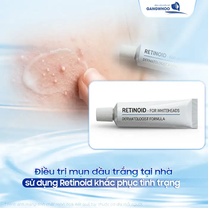 Mụn đầu trắng và cách điều trị chuẩn y khoa, sạch mụn nhanh