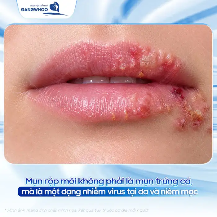 Mụn rộp ở môi và cách điều trị đúng cách để ngừa tái phát