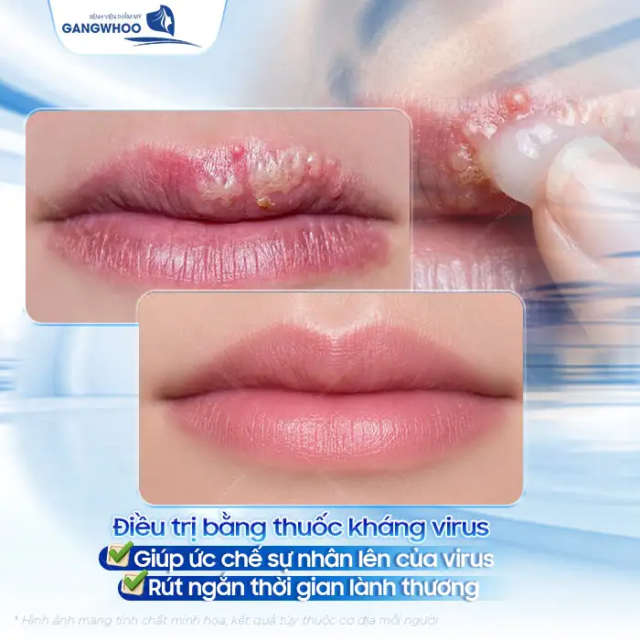 Mụn rộp ở môi và cách điều trị đúng cách để ngừa tái phát