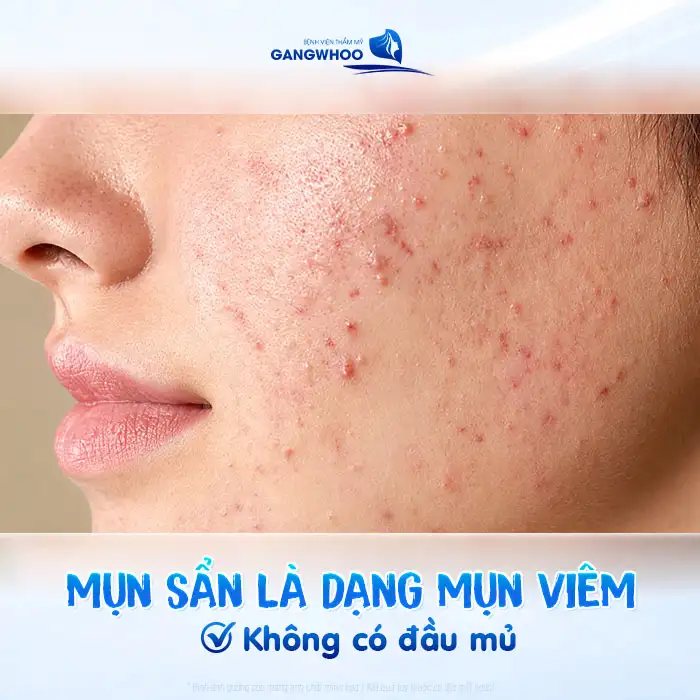 Mụn sẩn là gì? Cách điều trị mụn sẩn an toàn, hiệu quả