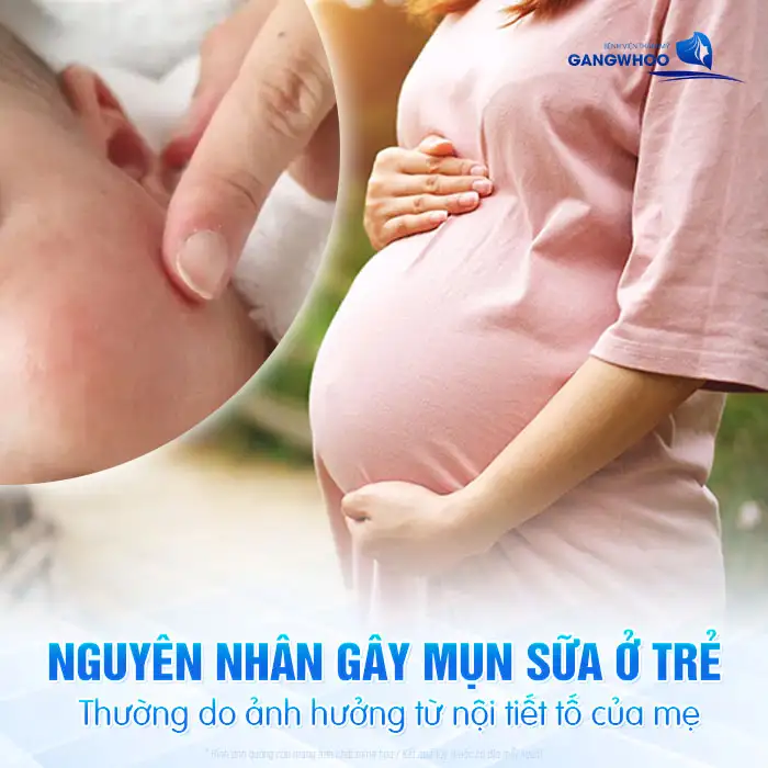 Mụn sữa là gì? Và cách điều trị mụn sữa an toàn cho trẻ sơ sinh