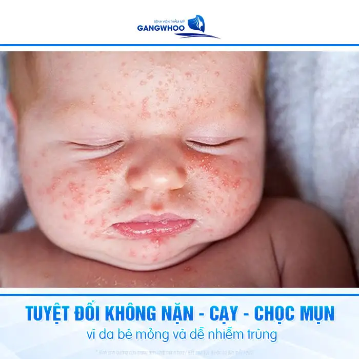 Mụn sữa là gì? Và cách điều trị mụn sữa an toàn cho trẻ sơ sinh