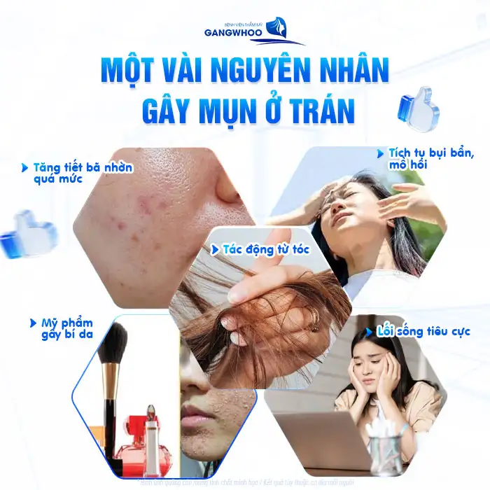Tìm hiểu về mụn trán và cách điều trị an toàn, hiệu quả